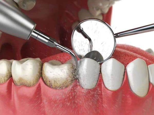 Профессиональная гигиена зубов: что это такое и зачем она нужна. Как делается профессиональная чистка зубов