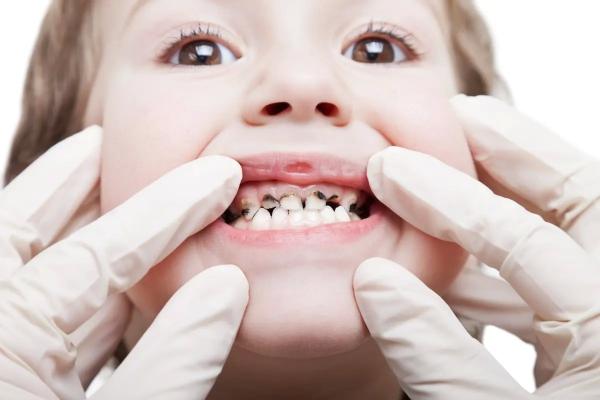 Какие заболевания могут возникнуть, если не лечить детские зубы? Надо ли лечить молочные зубы?